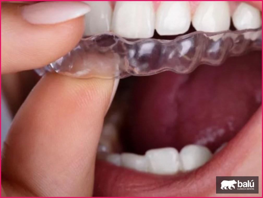 Brackets invisibles: tipos de ortodoncia estética que existen