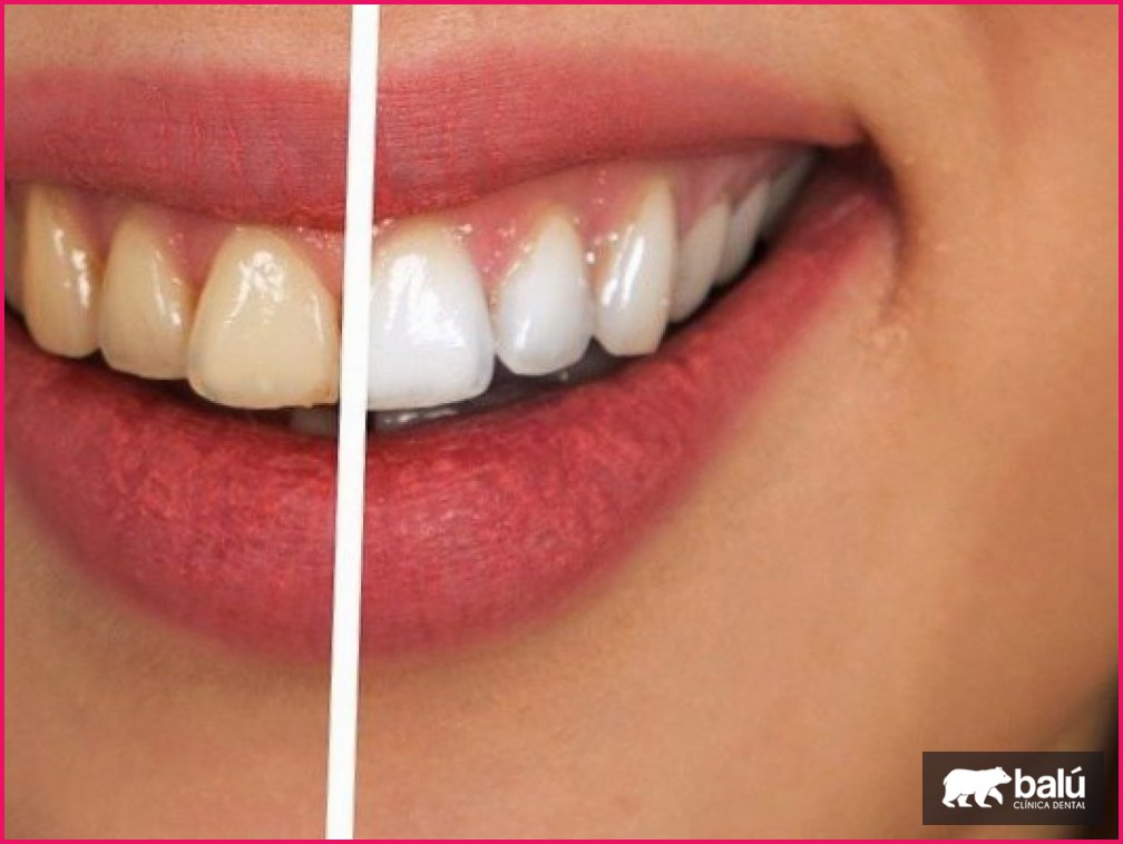 Cómo es una limpieza dental profesional, paso a paso